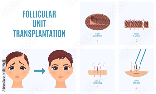 Female hair loss treatment with follicular unit transplantation. Strip method. Stages of FUT procedure. Alopecia medical template. Clinics and diagnostic centers concept design. Vector illustration.