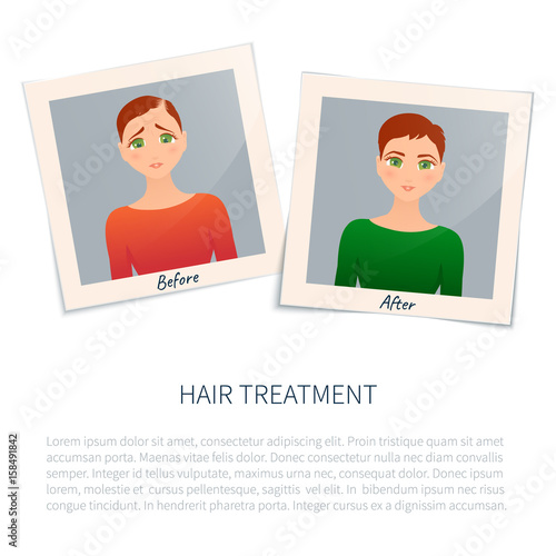 Vector illustration of two photographs of a woman before and after hair treatment and transplantation. Female alopecia stages design template with place for text. Medical concept.