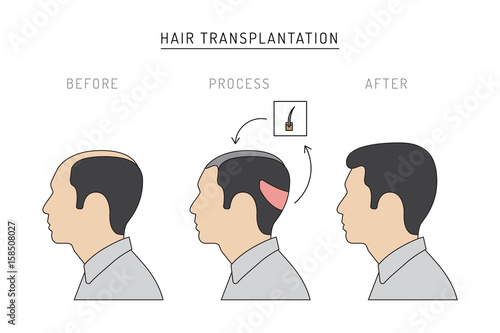 Infographics on the subject of hair transplantation on the example of a man with a picture of the result of transplantation before and after. Vector image of a patient isolated on white background
