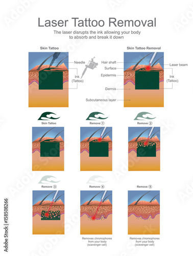 Tattoo removal is most commonly performed using lasers that break down the ink particles in the tattoo. Education infographic. Vector design.