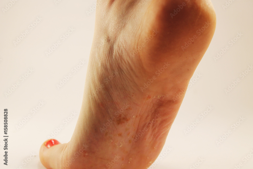 Fototapeta premium Fungus of foot close-up, isolated on white background. The concept dermatology, treatment fungal and fungal infections in humans. Macro photograph human parasites. Rear background of a dermatologist