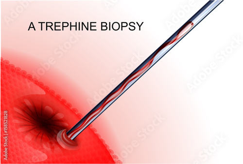 trephine biopsy cancer tumor photo