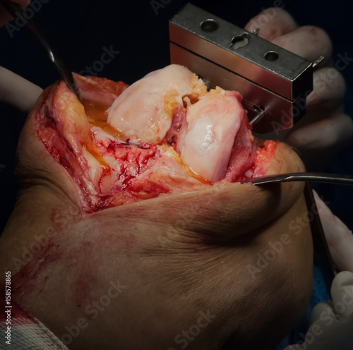 Картината върху платно Knee surgery: Exposed kneecap