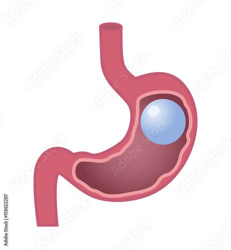 Gastric Balloon Stomach