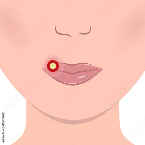 Herpes on Lips Cold Sore