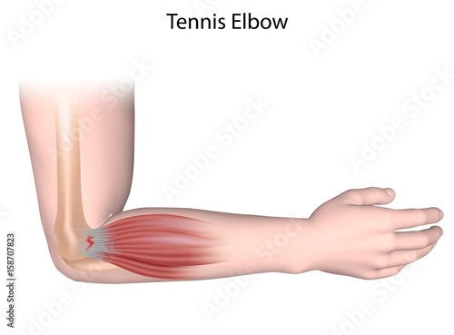 Canvas Print Tennis elbow