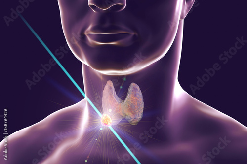 Destruction of thyroid nodule by laser, 3D illustration. Conceptual image for thyroid tumor treatment