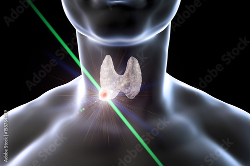 Destruction of thyroid nodule by laser, 3D illustration. Conceptual image for thyroid tumor treatment photo