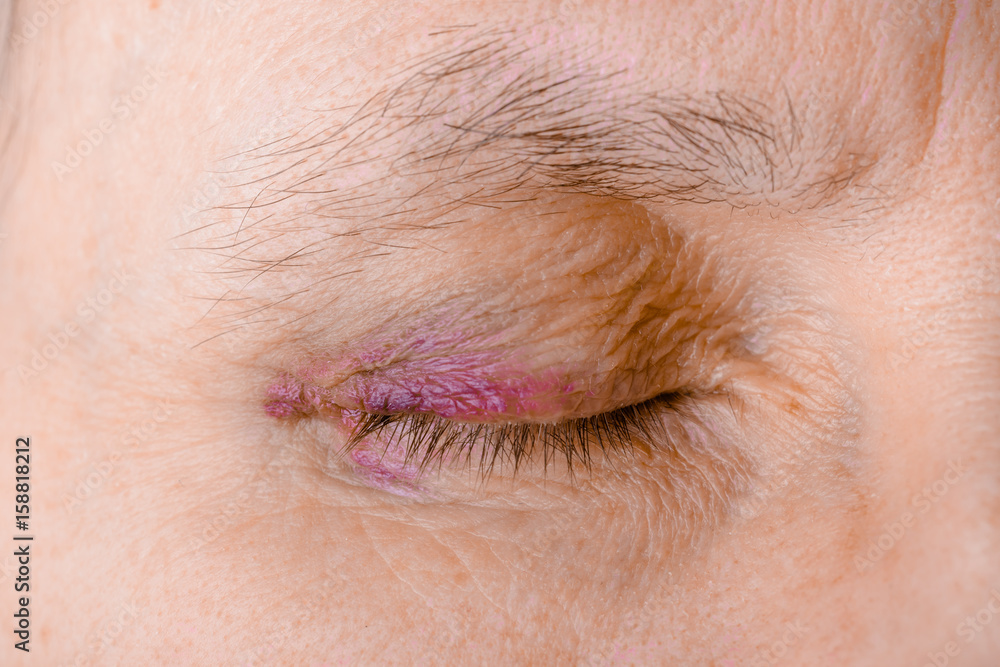 Woman's eye injured due to rupture of capillary, causing hematoma or bruising. It could also be conjunctivitis or other allergic eye inflammation Woman's eye injured due to rupture of capillary, causing hematoma or bruising. It could also be conjunctivitis or other allergic eye inflammation