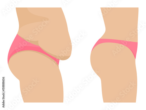 Vector female abdomen before after losing weight