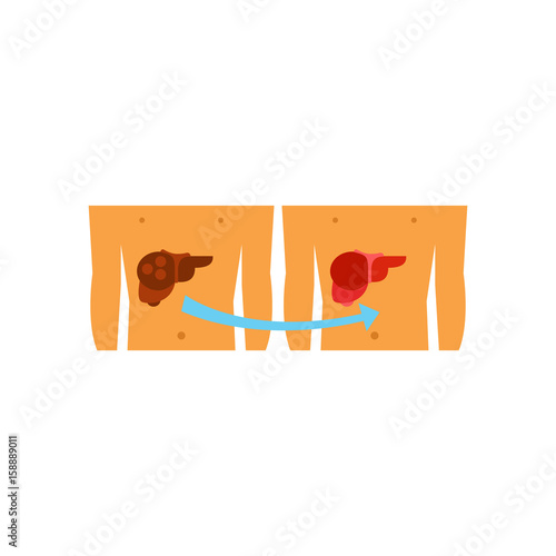 Liver transplantation vector icon