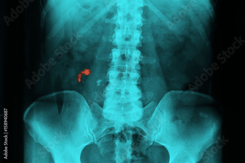 Renal lithiasis, x-ray photo