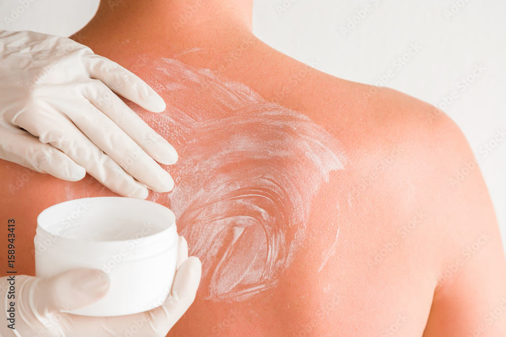 On young man's back skin hands in white rubber gloves smears cream after sun burn. On young man's back skin hands in white rubber gloves smears cream after sun burn.