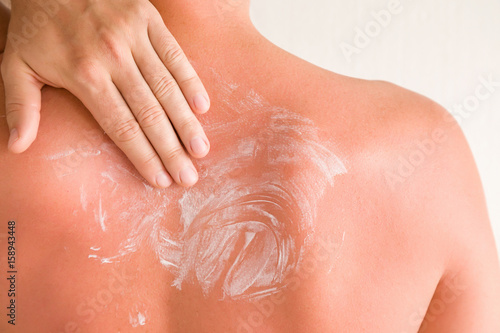 Young man smears cream on his back skin after sun burn.