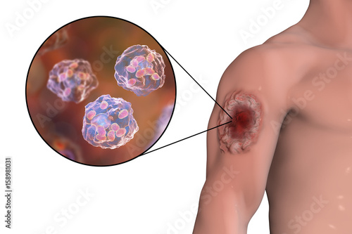 Cutaneous leishmaniasis ulcer and close-up view of Leishmania amastigotes infected human histiocyte cells, 3D illustration photo