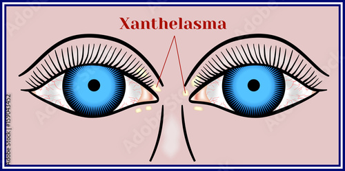 Xanthelasma. Flattened benign neoplasm.