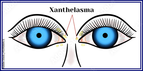 Xanthelasma. Flattened benign neoplasm.