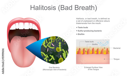 Halitosis, or bad breath, is defined as a set of unpleasant or offensive odors.That emanate from the mouth. Education info graphic. Vector design. photo
