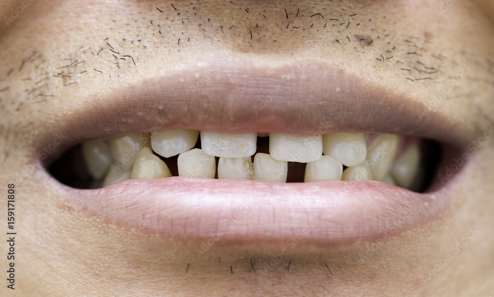 Obraz premium Yellow teeth