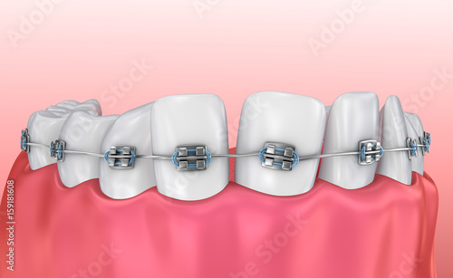 Teeth with braces isolated on white. Medically accurate 3D illustration