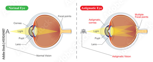 The different between vision of normal eye and Astigmatic. Illustration about common eye problem.