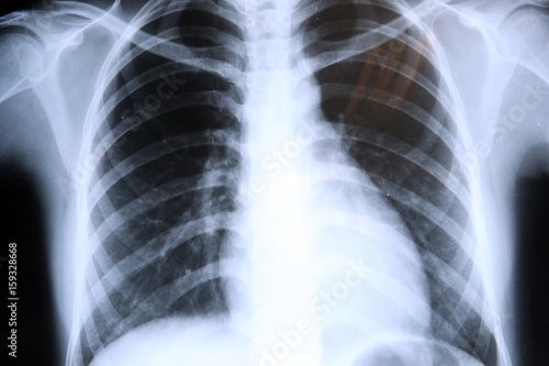 Lungs radiography. x-rays. photo