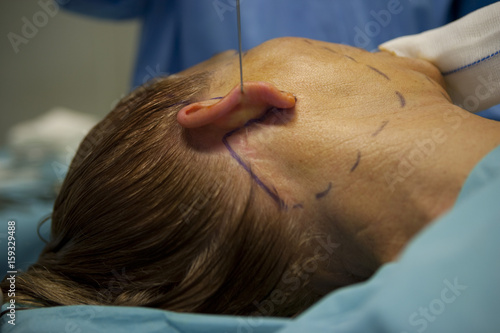 FACE PLASTIC SURGERY