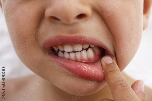 PAINFUL TOOTH IN A CHILD photo