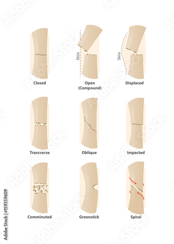 Type of fracture illustration vector on white background. Health concept.