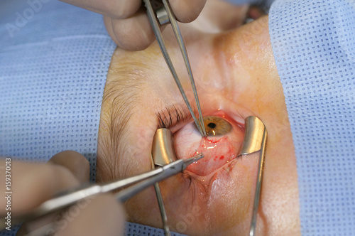 STRABISMUS, SURGERY