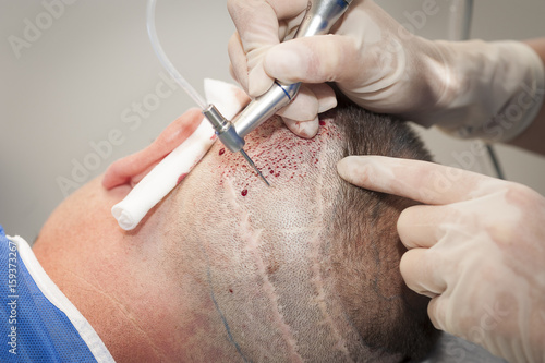 HAIR TRANSPLANTATION