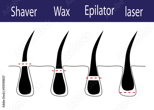 Vector diagram of different methods of hair removal