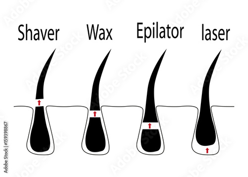 Vector diagram of different methods of hair removal