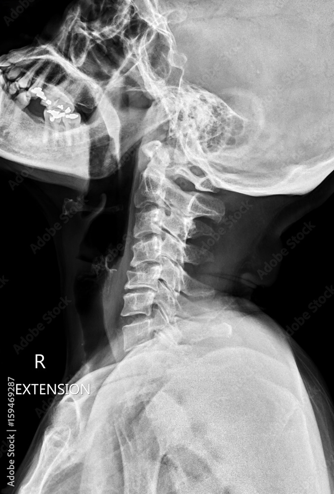 Xray of cervical spine (neck) extended position Stock Photo Adobe Stock