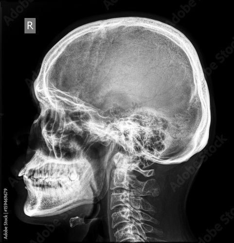 Skull X-ray of normal subject