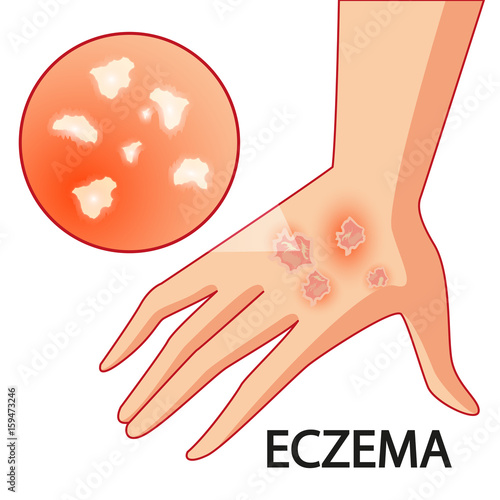 Psoriasis. Skin problems. Vector. Cartoon. Isolated. Flat. Illustration for websites, brochures, magazines. Medicine.