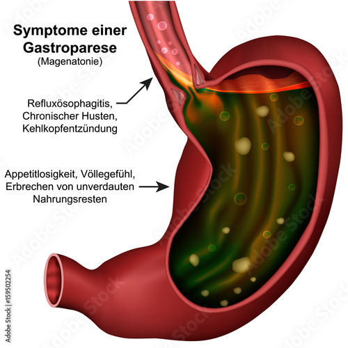 Symptome einer Gastroparese