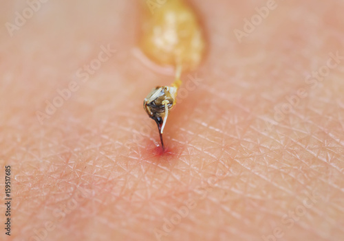 sharp bee sting with a bag of poison broke the skin