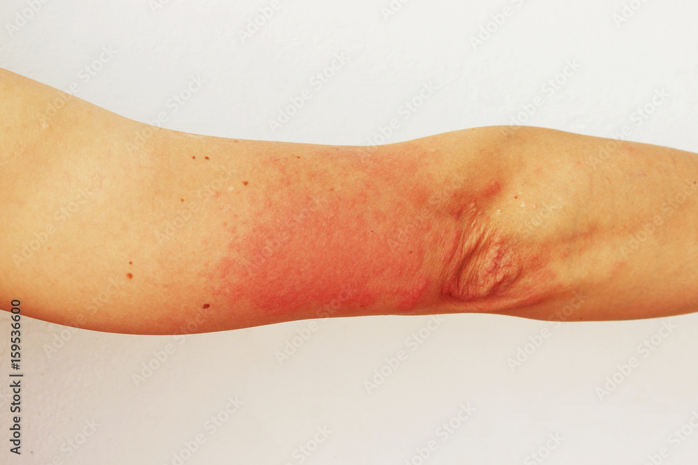 Red pustules and vesicles on the skin of the hand as symptoms of