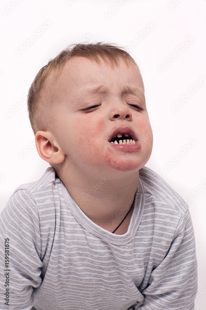 Dermatitis toddler with ginger hair Dermatitis toddler with ginger hair