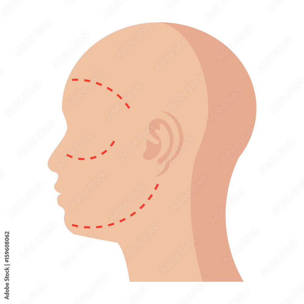 Human with marks on skin for facial plastic surgery, vector illustration in flat style Human with marks on skin for facial plastic surgery, vector illustration in flat style