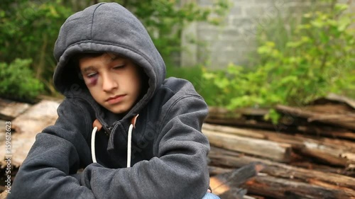 The boy is a teenager with a hematoma and a bruised eye that looks into the camera. photo