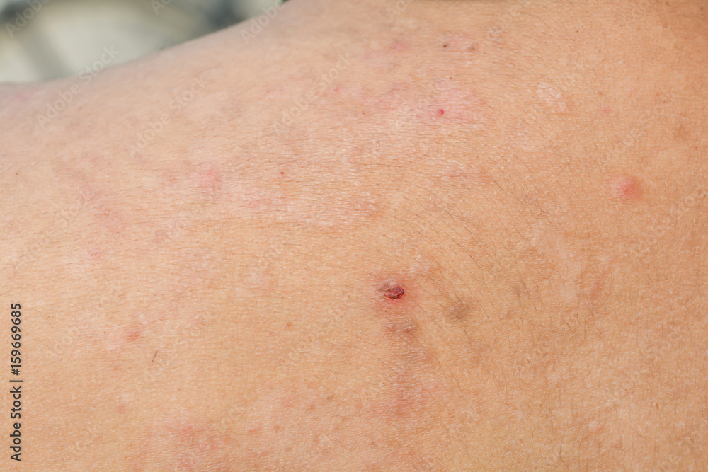 Psoriasis on the skin Psoriasis on the skin