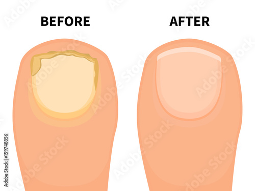 Vector toe nail before and after fungal disease