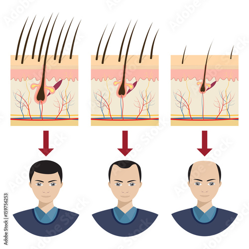 Hair loss illustration.