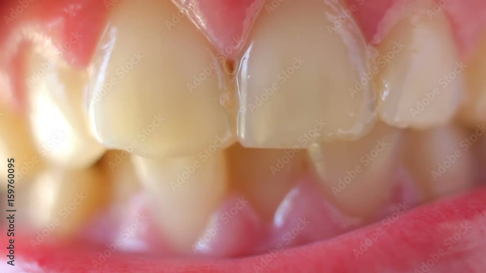A close-up of crooked teeth A close-up of crooked teeth