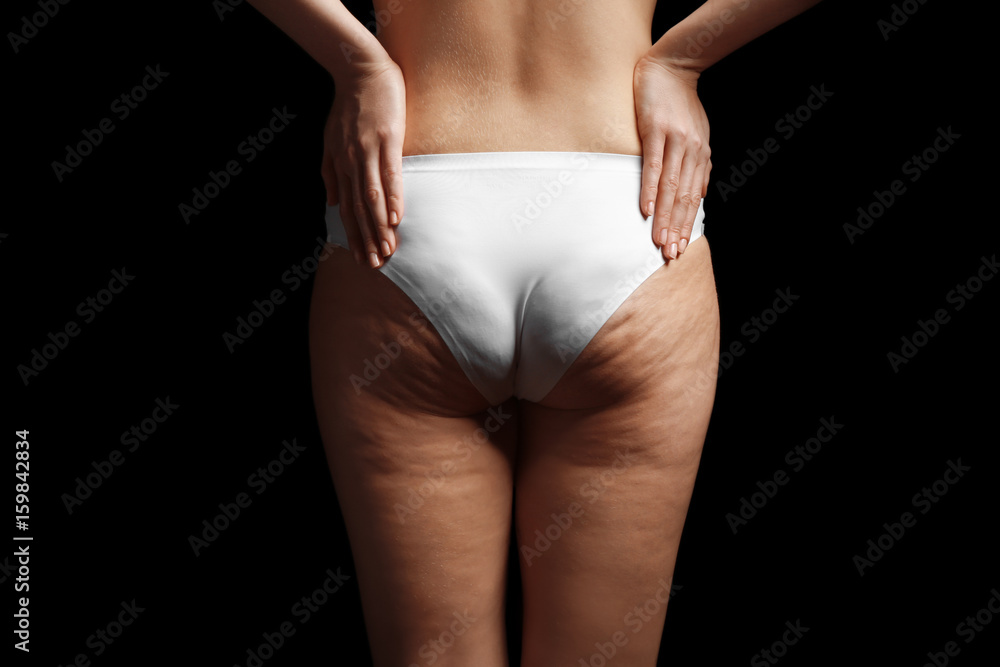 Fototapeta premium Woman with cellulite problem on black background