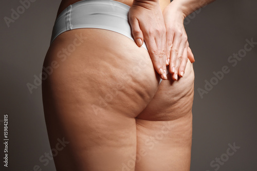 Fotografie, Obraz Woman with cellulite problem on dark background