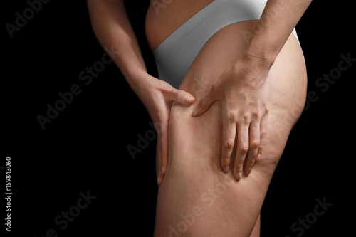 Woman with cellulite problem on black background