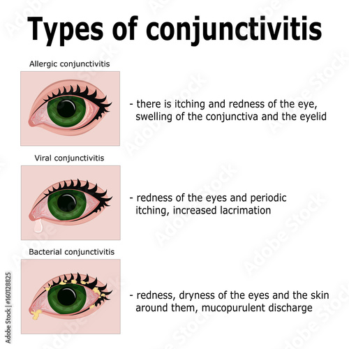 Types of conjunctivitis photo